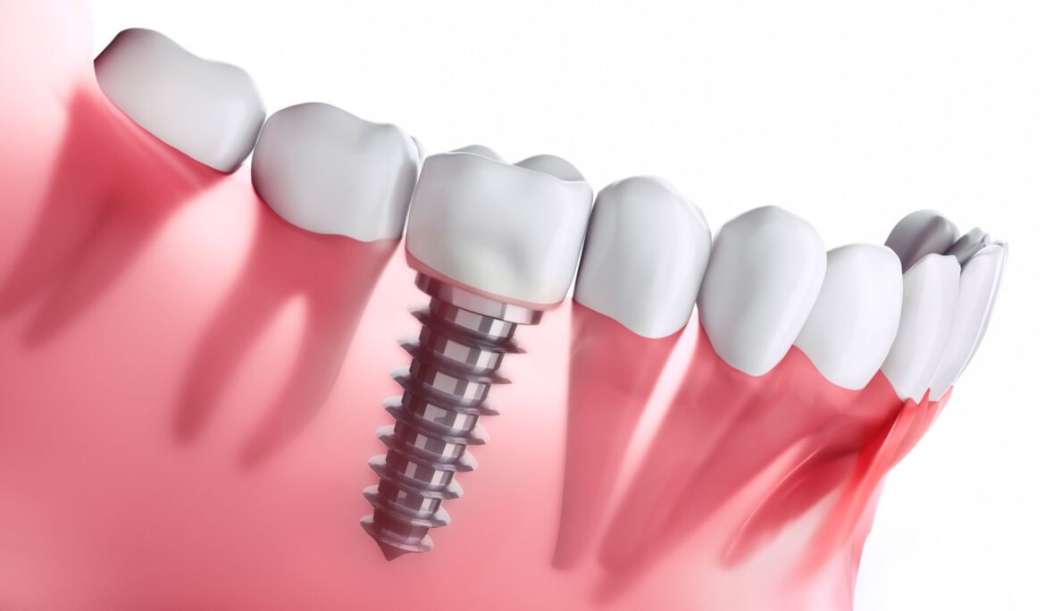 Dental Implants, best tooth replacement, high-quality dental care, natural-looking implants, durable tooth restoration