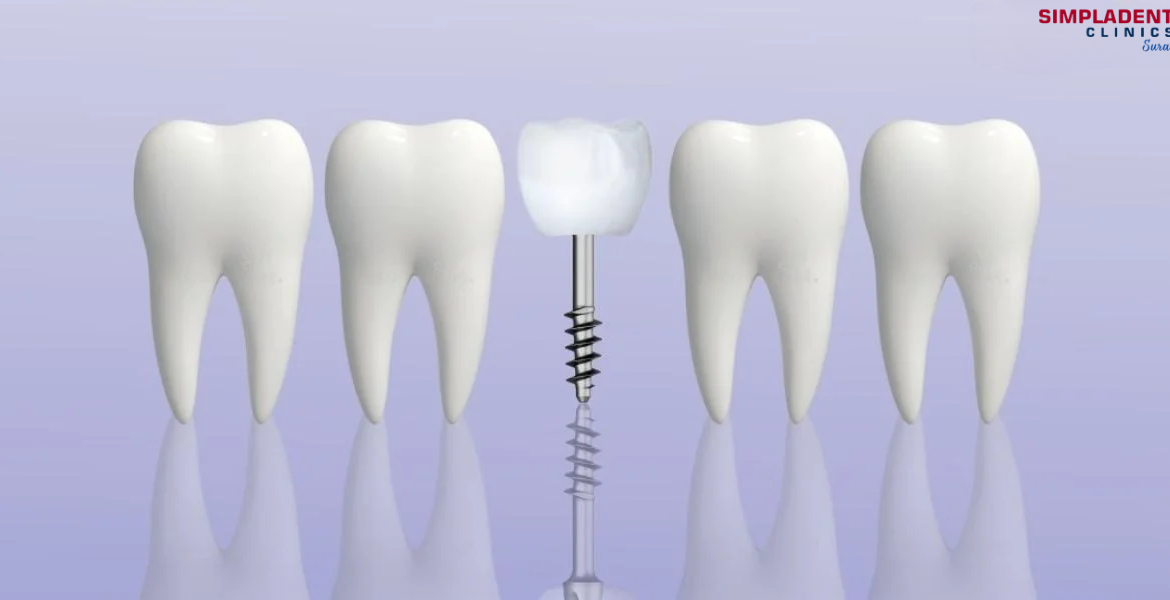 Advanced dental implants for missing teeth solution, permanent teeth restoration, best smile makeover, modern implant technology, full mouth dental implants