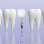 Advanced dental implants for missing teeth solution, permanent teeth restoration, best smile makeover, modern implant technology, full mouth dental implants