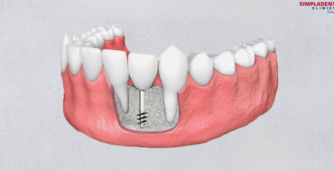 Advanced dental implants in Surat for permanent missing teeth solutions, cutting-edge dental technology, full-mouth restoration, and confident smiles.