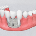 Advanced dental implants in Surat for permanent missing teeth solutions, cutting-edge dental technology, full-mouth restoration, and confident smiles.